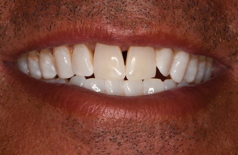 Teeth Whitening Before & After Gallery - Patient 330352 - Image 2
