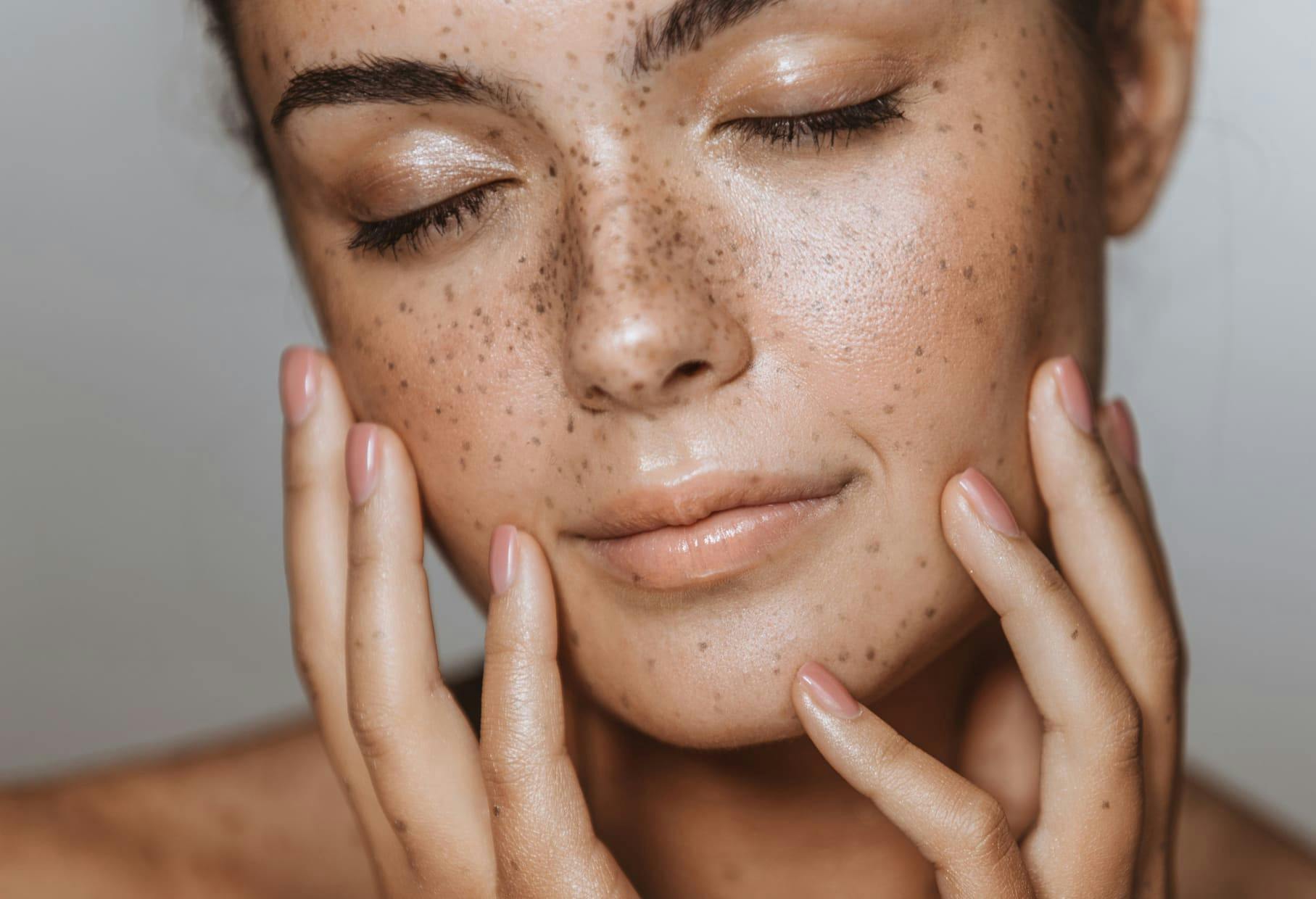 woman with freckles touching her cheeks with her hands with her eyes closed