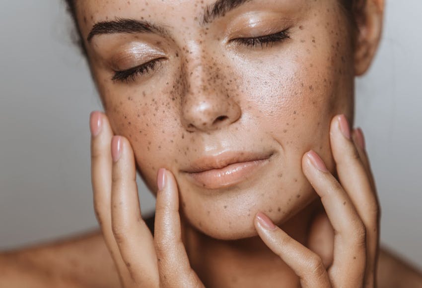 woman with freckles touching her cheeks with her hands with her eyes closed