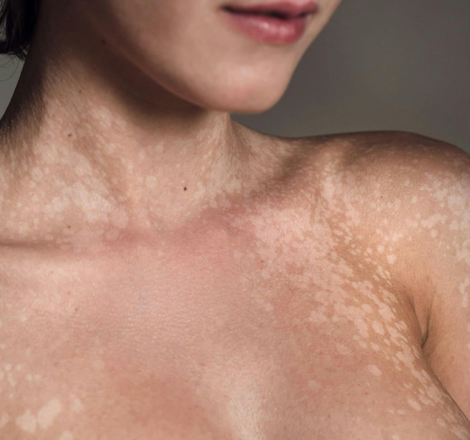 woman's neck area with lighter skin patches