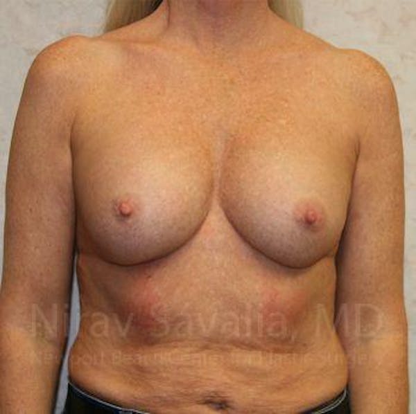 Breast Implant Revision Gallery - Patient 1655444 - Image 1