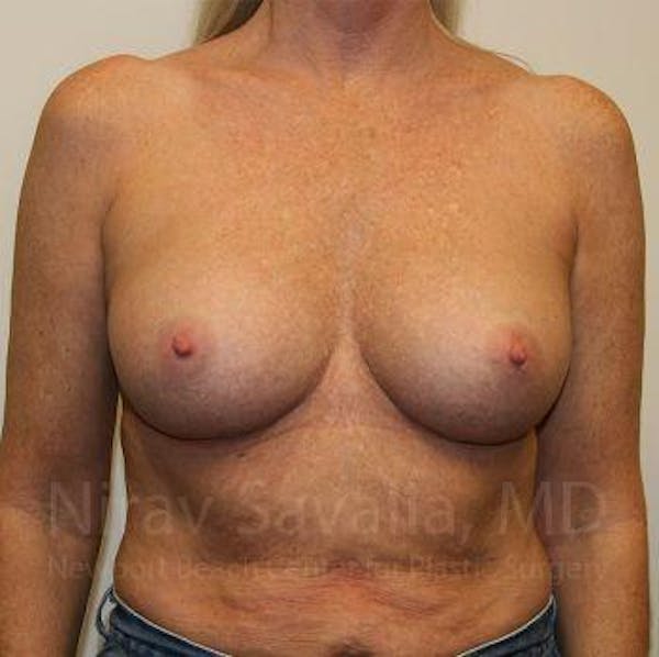 Breast Implant Revision Before & After Gallery - Patient 1655444 - Image 2