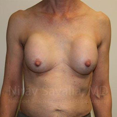 Breast Implant Revision Gallery - Patient 1655447 - Image 1