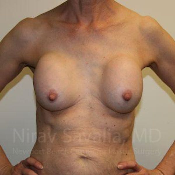 Breast Implant Revision Before & After Gallery - Patient 1655447 - Image 3