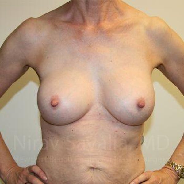 Breast Implant Revision Before & After Gallery - Patient 1655447 - Image 4
