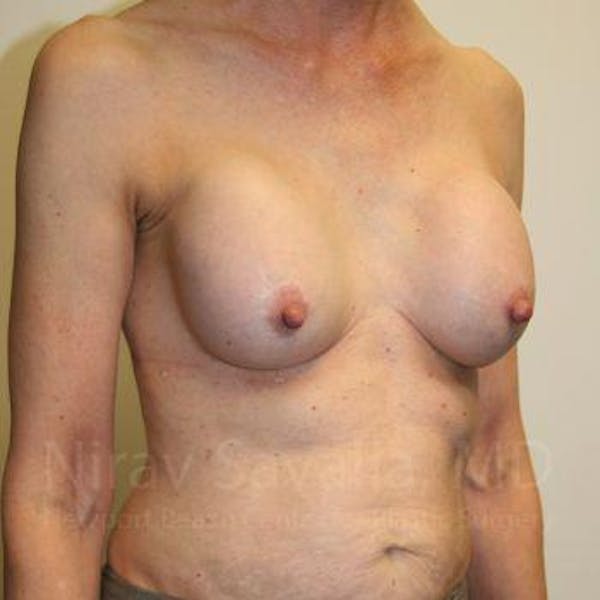 Breast Implant Revision Before & After Gallery - Patient 1655447 - Image 9