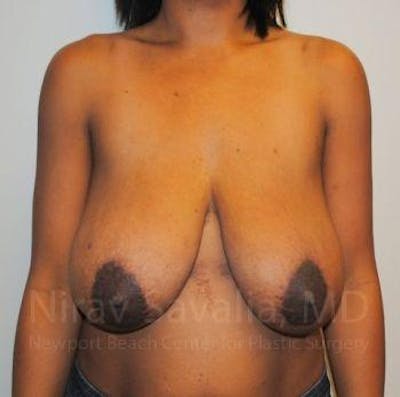 Breast Reduction Before & After Gallery - Patient 1655451 - Image 1