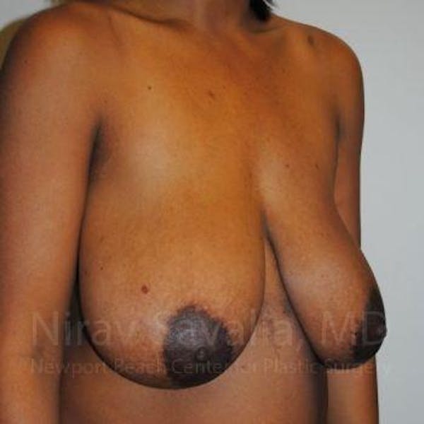 Breast Reduction Before & After Gallery - Patient 1655451 - Image 5