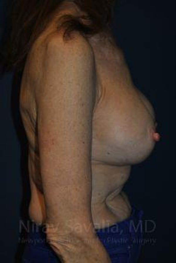 Breast Implant Revision Before & After Gallery - Patient 1655452 - Image 3