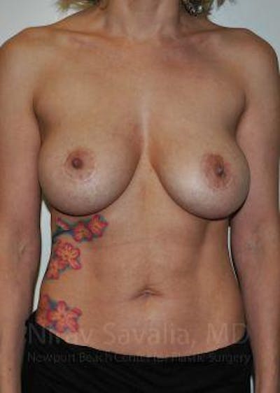 Breast Lift with Implants Before & After Gallery - Patient 1655455 - Image 1