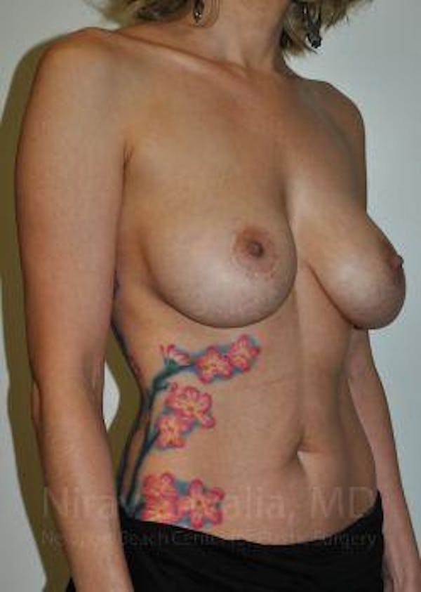 Breast Lift with Implants Before & After Gallery - Patient 1655455 - Image 3