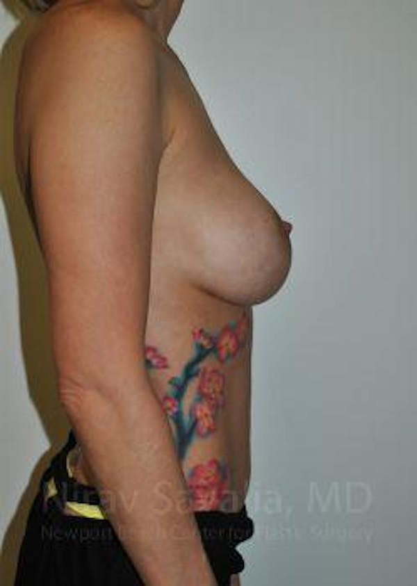 Breast Lift with Implants Before & After Gallery - Patient 1655455 - Image 9