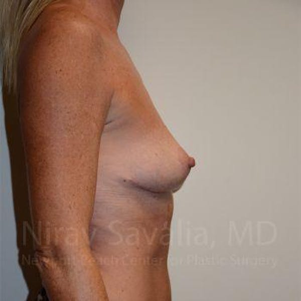 Breast Explantation / En Bloc Capsulectomy Before & After Gallery - Patient 1655456 - Image 8