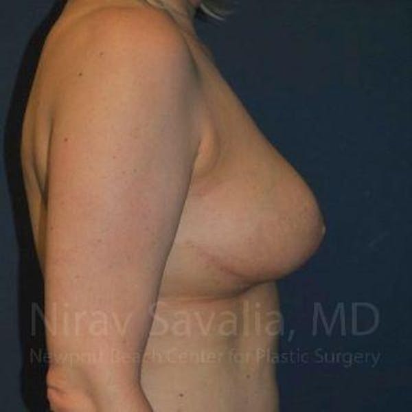 Breast Reduction Before & After Gallery - Patient 1655461 - Image 8