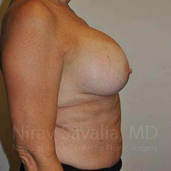 Breast Implant Revision Before & After Gallery - Patient 1655463 - Image 5