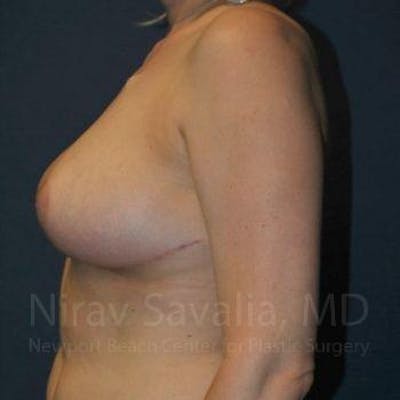 Breast Reduction Before & After Gallery - Patient 1655461 - Image 10