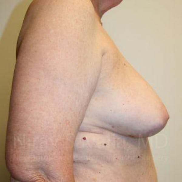 Oncoplastic Reconstruction Before & After Gallery - Patient 1655457 - Image 7