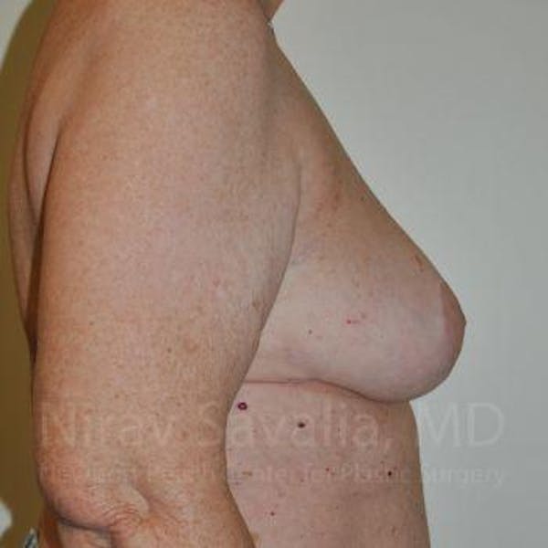 Oncoplastic Reconstruction Before & After Gallery - Patient 1655457 - Image 8