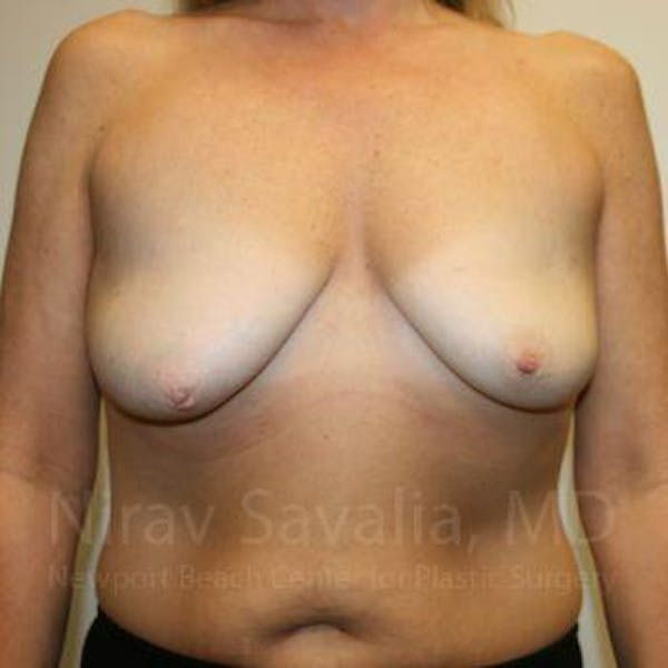 Mastectomy Reconstruction Before & After Gallery - Patient 1655464 - Image 1