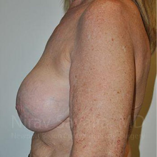 Breast Explantation / En Bloc Capsulectomy Before & After Gallery - Patient 1655462 - Image 11