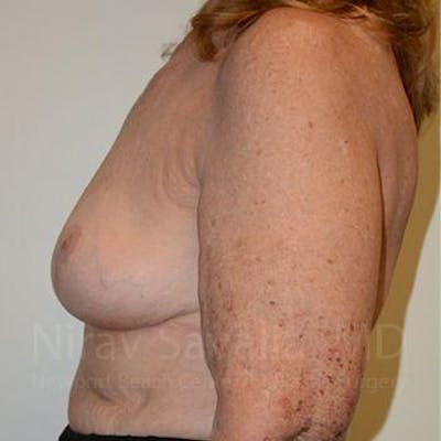 Breast Explantation / En Bloc Capsulectomy Before & After Gallery - Patient 1655462 - Image 12