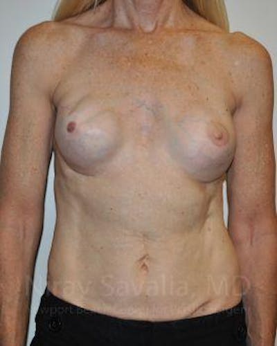 Mastectomy Reconstruction Revision Before & After Gallery - Patient 1655466 - Image 1