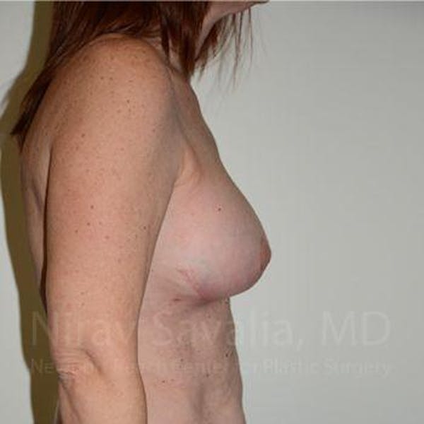 Breast Lift with Implants Before & After Gallery - Patient 1655467 - Image 4