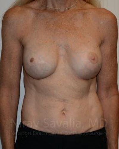Mastectomy Reconstruction Revision Gallery - Patient 1655466 - Image 2