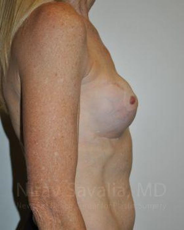 Mastectomy Reconstruction Revision Before & After Gallery - Patient 1655466 - Image 5
