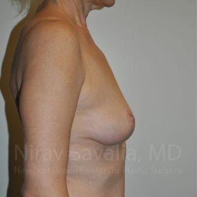 Breast Lift without Implants Before & After Gallery - Patient 1655472 - Image 4