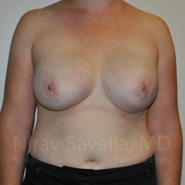 Mastectomy Reconstruction Before & After Gallery - Patient 1655468 - Image 2