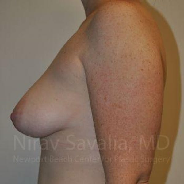 Mastectomy Reconstruction Before & After Gallery - Patient 1655468 - Image 5