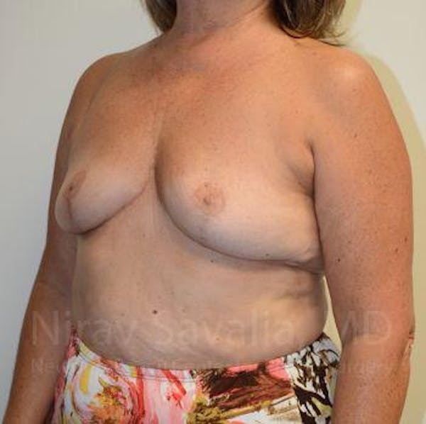 Breast Explantation / En Bloc Capsulectomy Before & After Gallery - Patient 1655471 - Image 6