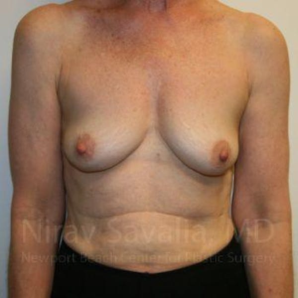 Oncoplastic Reconstruction Before & After Gallery - Patient 1655475 - Image 1