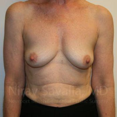 Oncoplastic Reconstruction Before & After Gallery - Patient 1655475 - Image 1