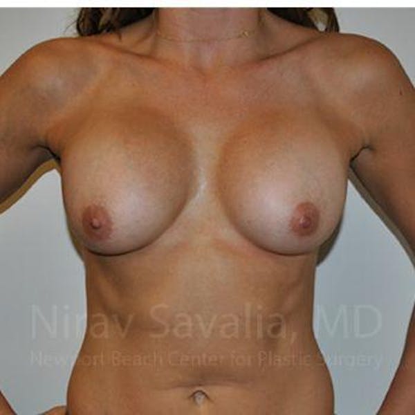 Breast Implant Revision Gallery - Patient 1655470 - Image 3