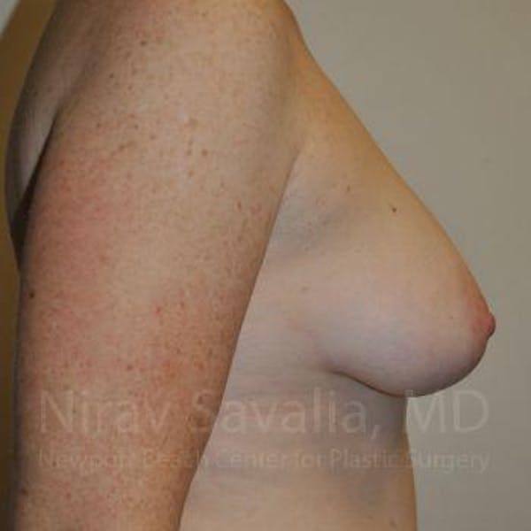 Mastectomy Reconstruction Before & After Gallery - Patient 1655468 - Image 7