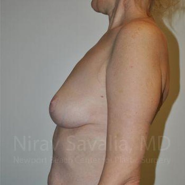 Breast Lift without Implants Before & After Gallery - Patient 1655472 - Image 6