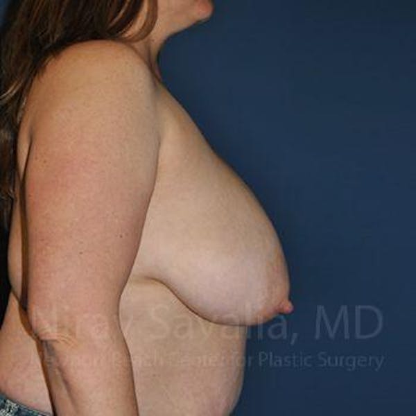 Breast Reduction Before & After Gallery - Patient 1655476 - Image 5