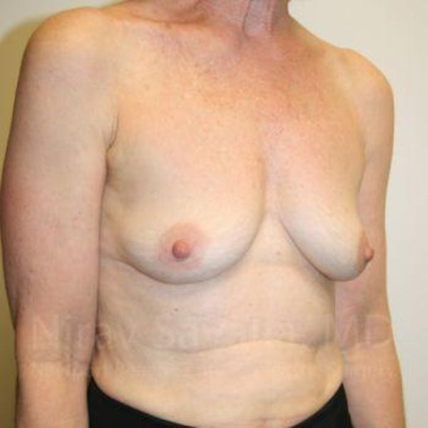 Oncoplastic Reconstruction Before & After Gallery - Patient 1655475 - Image 3
