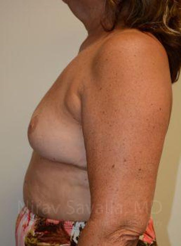 Breast Explantation / En Bloc Capsulectomy Before & After Gallery - Patient 1655471 - Image 10