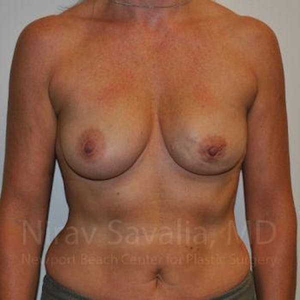 Mastectomy Reconstruction Before & After Gallery - Patient 1655474 - Image 1