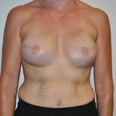 Mastectomy Reconstruction Gallery - Patient 1655474 - Image 2