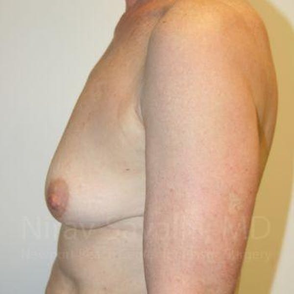 Oncoplastic Reconstruction Before & After Gallery - Patient 1655475 - Image 7