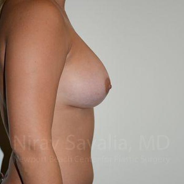 Breast Augmentation Before & After Gallery - Patient 1655477 - Image 4