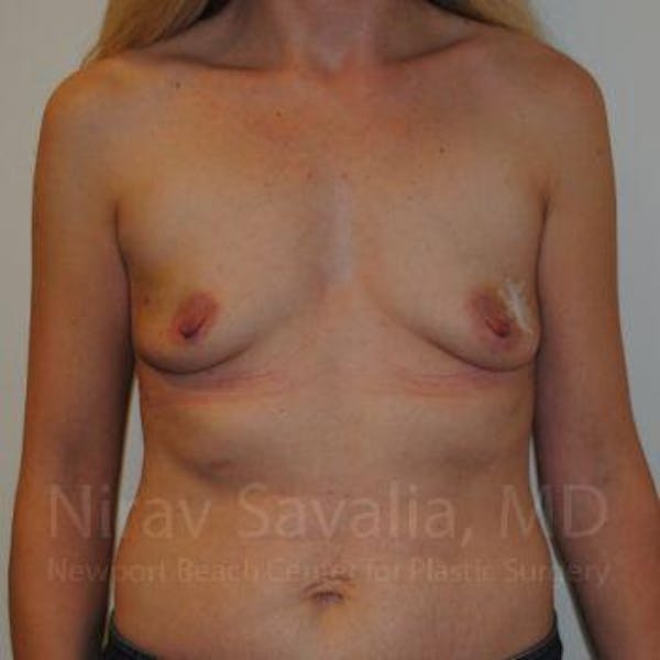 Mastectomy Reconstruction Gallery - Patient 1655479 - Image 1