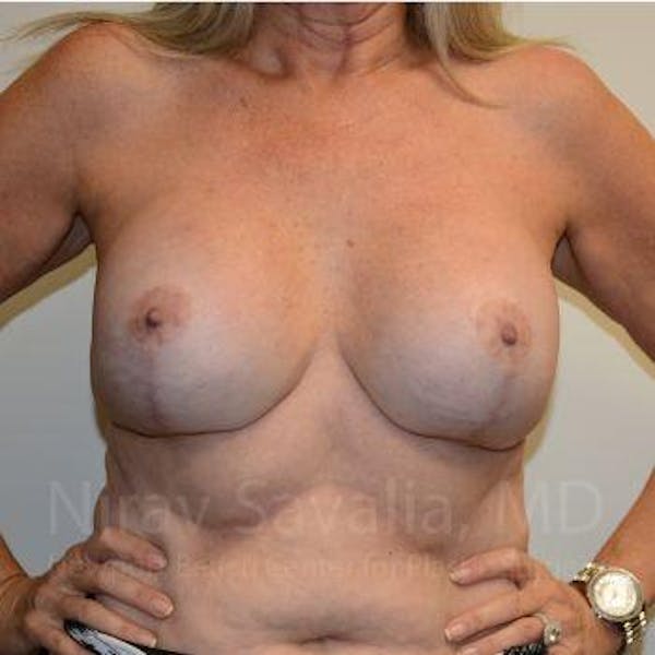 Breast Lift with Implants Before & After Gallery - Patient 1655483 - Image 4