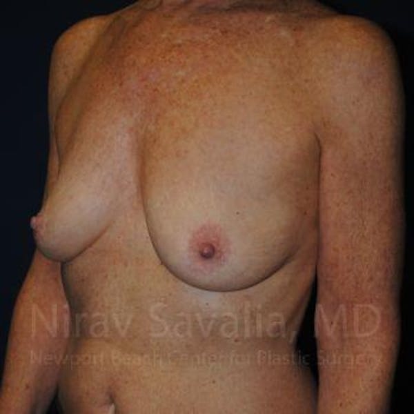 Oncoplastic Reconstruction Before & After Gallery - Patient 1655481 - Image 5