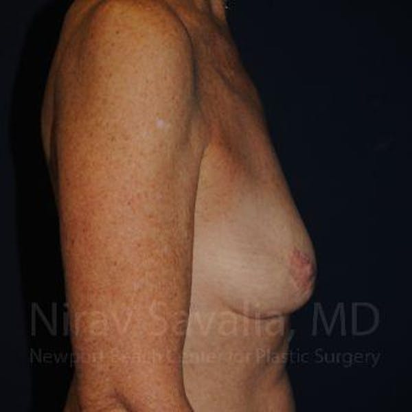 Oncoplastic Reconstruction Before & After Gallery - Patient 1655481 - Image 7
