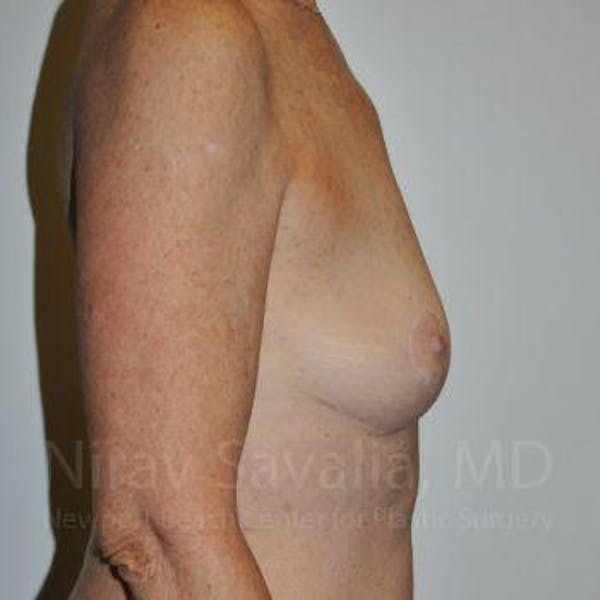 Oncoplastic Reconstruction Before & After Gallery - Patient 1655481 - Image 8